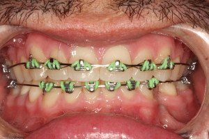 orthodontics in Coimbatore
