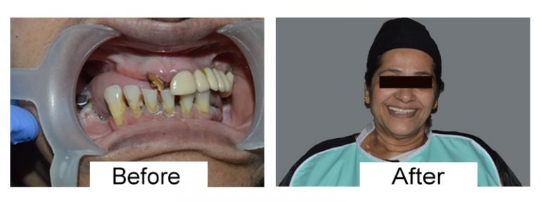 Dental implant cost in Coimbatore
