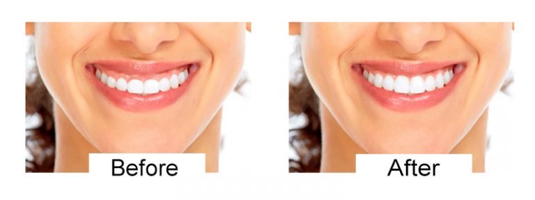 gummy smile correction
