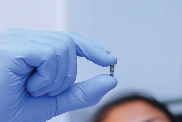 dental implants in coimbatore