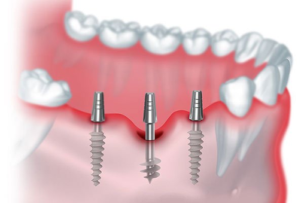 Strategic Implant service in coimbatore