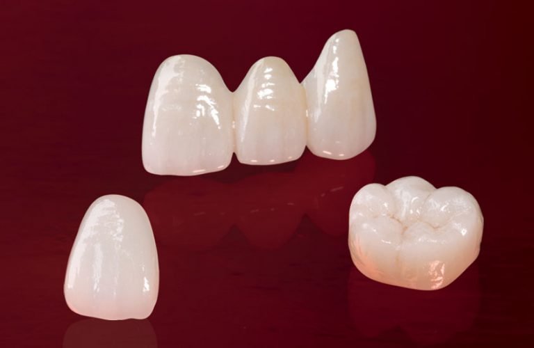 Dental Crowns in Coimbatore