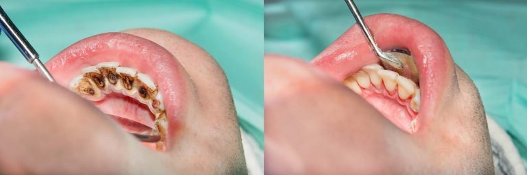 Patient having Gum Disease