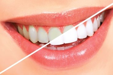 teeth whitening in coimbatore