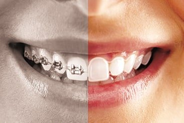 Teeth braces cost in Coimbatore